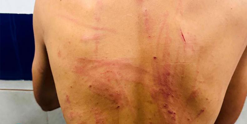 DISCIPLINA: Menino de 14 anos tem braços e costelas quebrados por membros de facção