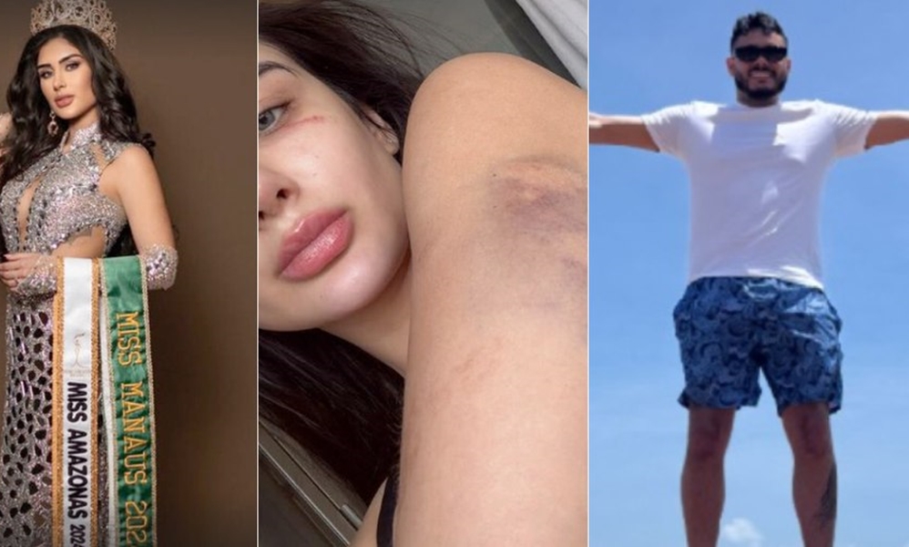 FORAGIDO: Agressor de Miss Amazonas foge de hospital para evitar prisão