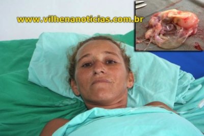 VILHENA -  Mulher é salva após médicos descobrirem feto em seu intestino