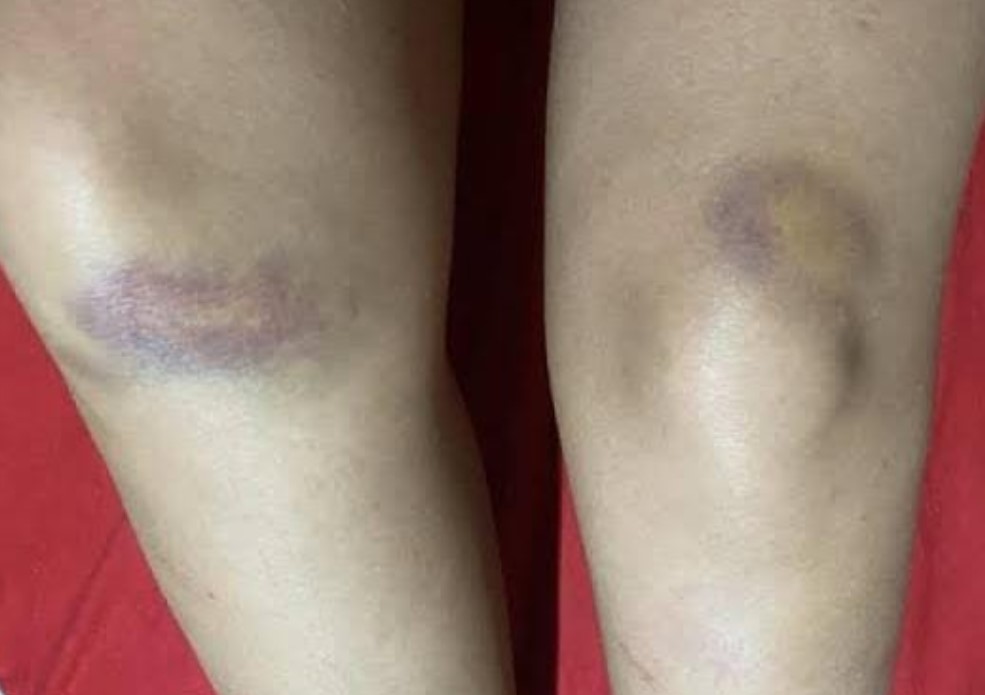 ACUSADO FUGIU: Após terminar relacionamento, mulher é atacada a pauladas e socorrida à UPA