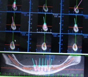 Implante dentário sem corte ou pontos, confira 