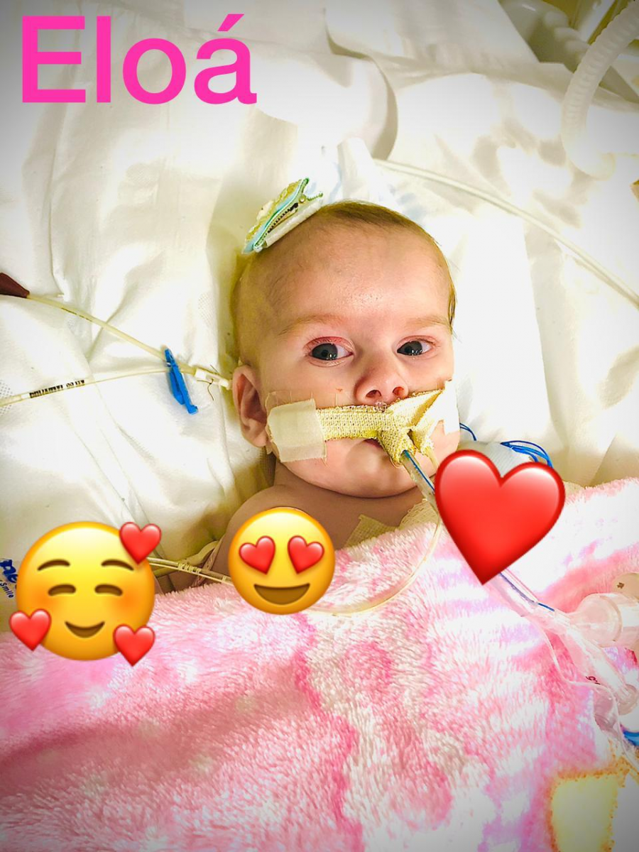 ALEGRIA: Casal de RO comemora cirurgia de separação de filhas siamesas