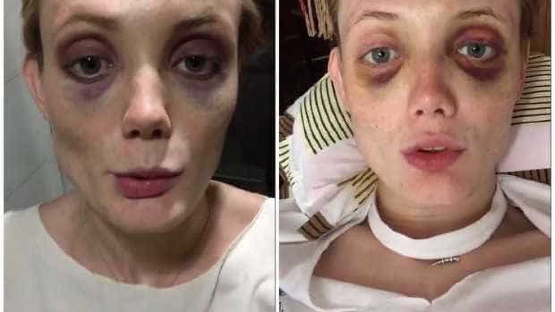 REDES SOCIAIS: Modelo russa mostra hematomas e denuncia agressões de ex-namorado