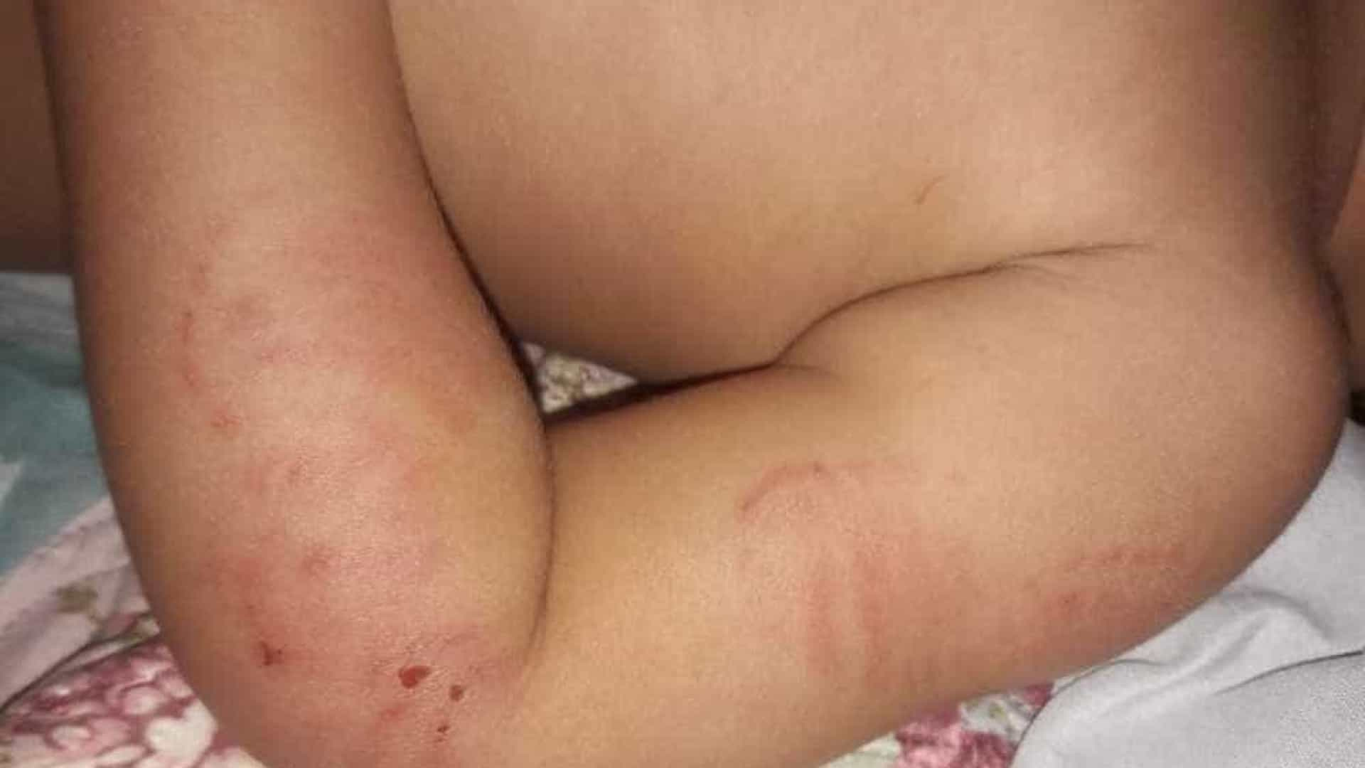 ABSURDO: Bebê leva 14 mordidas no primeiro dia em creche particular