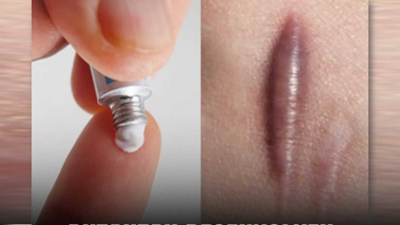 QUELOIDES:  Butantan desenvolve pomada cicatrizante que regenera a pele sem deixar marcas